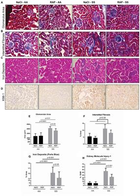 Receptor for Advanced Glycation End Products Antagonism Blunts Kidney Damage in Transgenic Townes Sickle Mice